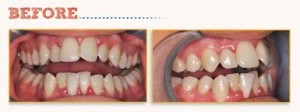 [Clinical Article] Lower Incisor Extraction with Six Month Smiles®