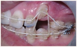 Six Month Smiles Before During After