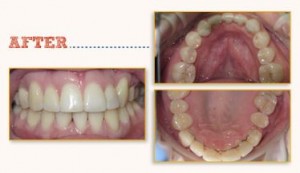 Six Month Smiles Before After