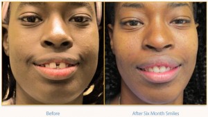 Teeth Straightening. The Power of Six Month Smiles.