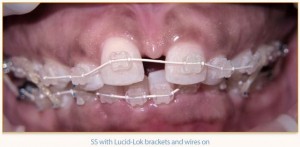 During Six Month Smiles with Clear Braces