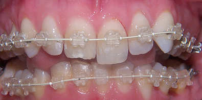 Six Month Smiles, adult braces