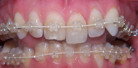 Six Month Smiles, adult braces Six Month Smiles, adult braces