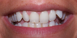 Six Month Smiles, adult braces