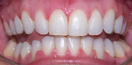 Six Month Smiles, adult braces