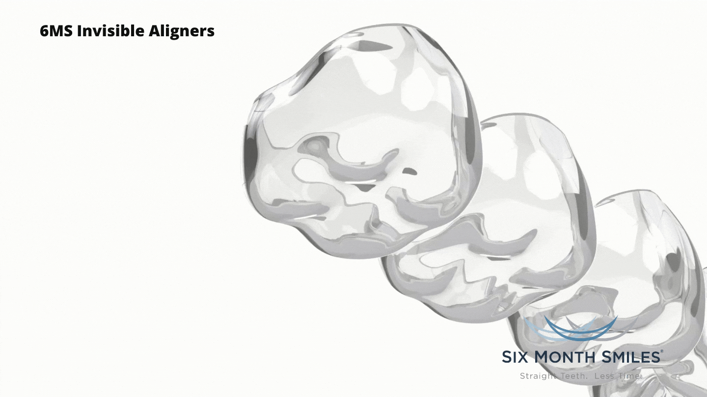 6MS Invisible Aligners