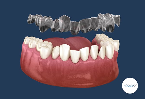 Aligners and tooth movement