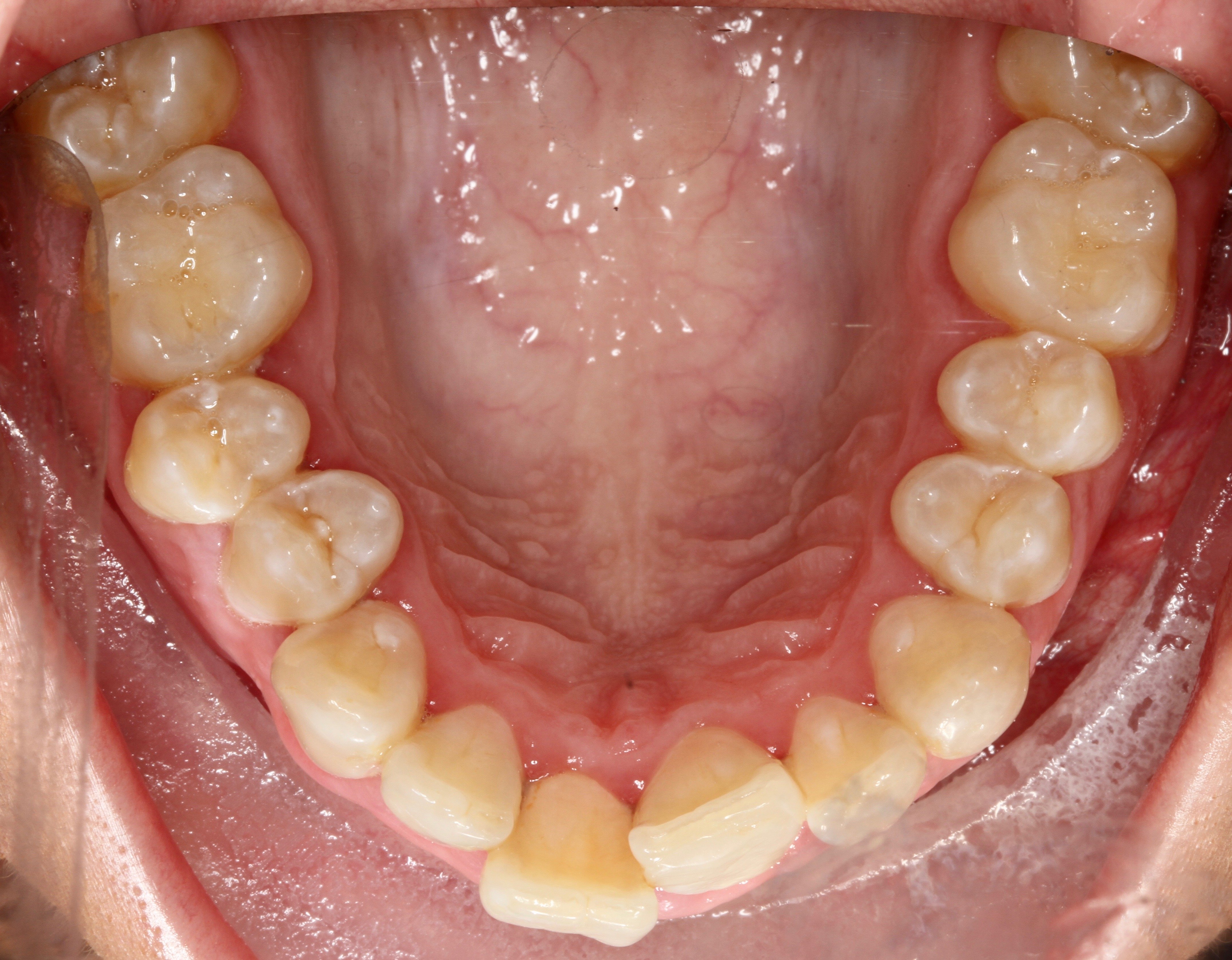 Clinical Case Review & Patient Testimonial: Aligner Mixed Therapy Case