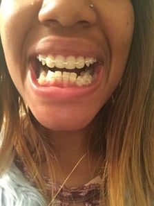 Tamara_4_Braces_On.jpg