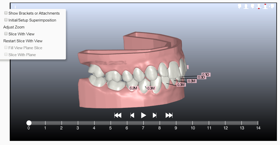 What are Aligner Attachments and Why Do I Need Them?