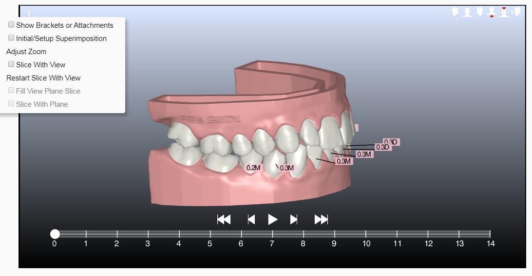 confidex aligner simulation without attachments