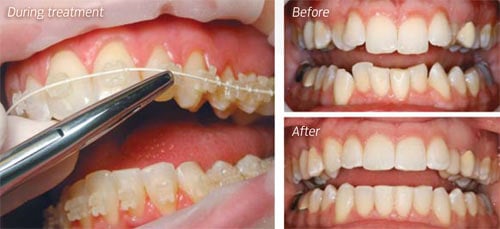 clear braces  minimally invasive dentistry