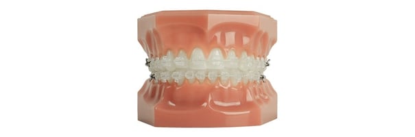 Six Month Smiles clear braces models with brackets and wires
