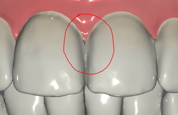 IPR Guidance for Aligner Cases